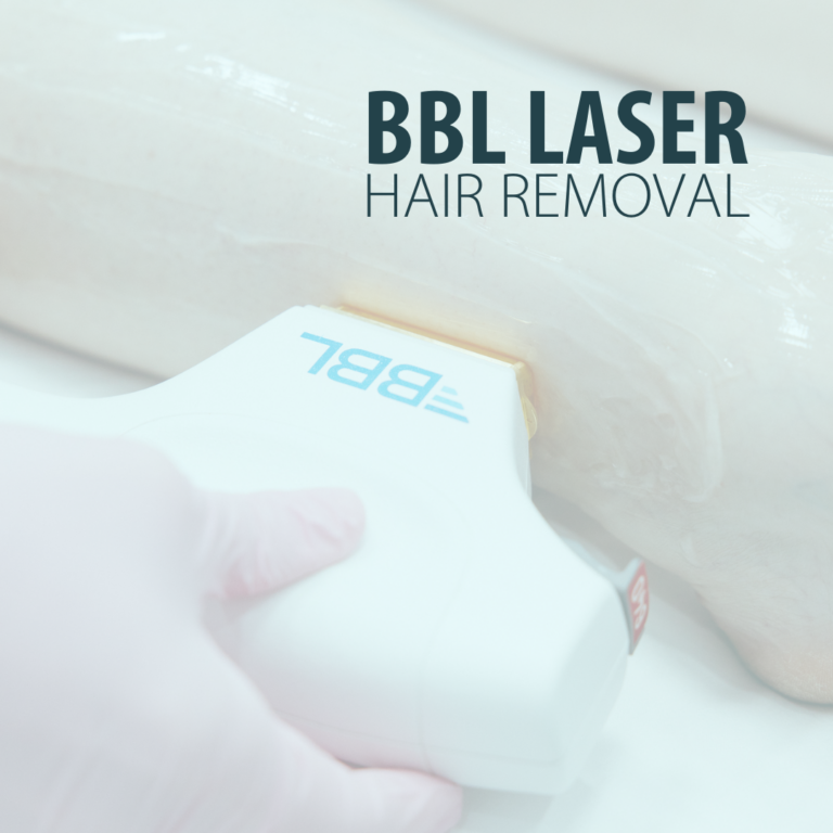 BBL Laser Hair Removal at Radiance Medspa Louisville